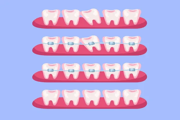 Soluciones para los Dientes Separados