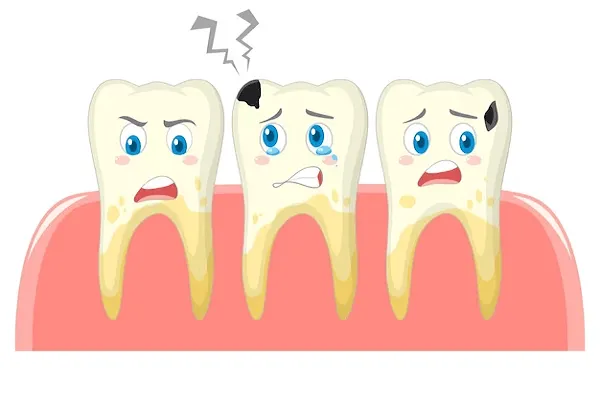 Qué son las Caries en el Esmalte