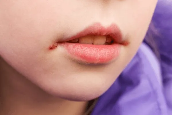 Descubrir las Ragades Labiales Prevención y Cura