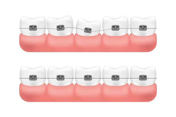 Brackets para Dientes Separados: Una solución eficaz