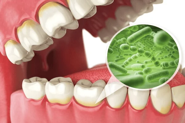 Tetraciclina y su efecto en los dientes