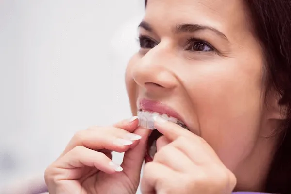Beneficios y desventajas de usar Invisalign