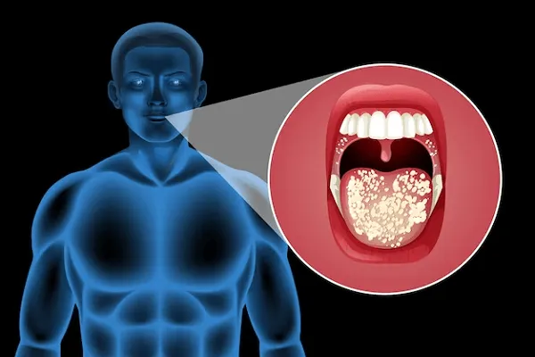 Candidiasis en la lengua y paladar: ¿Cómo identificarla?