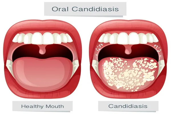 Causas más comunes de la Candidiasis Oral