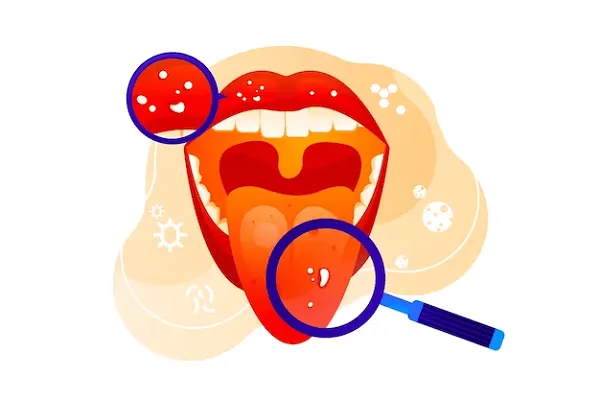 Estrategias para prevenir la Candidiasis en la lengua