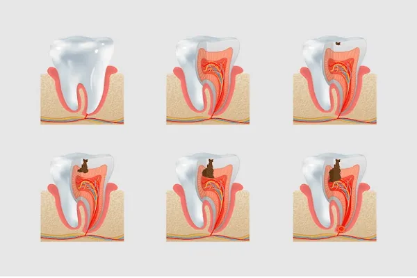 Todo sobre la pulpitis síntomas, causas y tratamiento