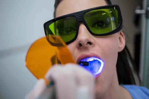 Todo sobre las Carillas Lumineers: Lo más buscado en estética dental
