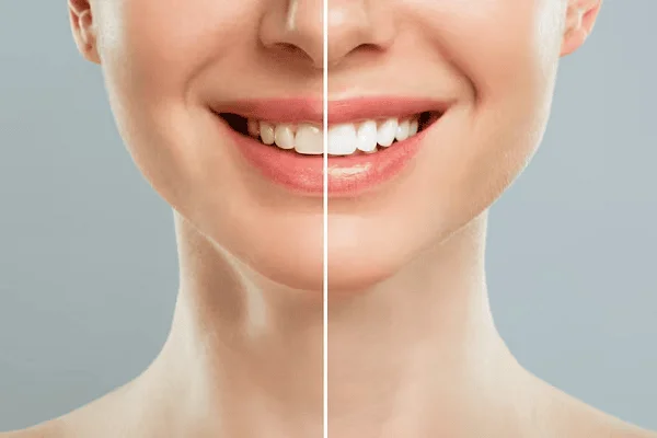 Todo sobre el blanqueamiento dental: duración y resultados