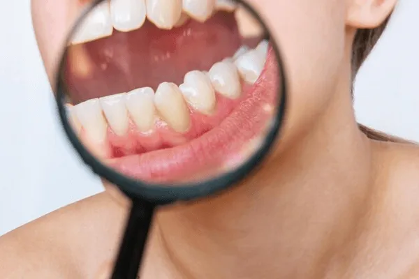 Qué son las Caries en el Esmalte