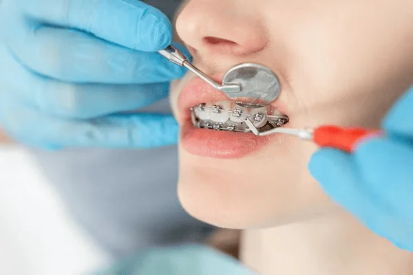Colocación de implantes con ortodoncia