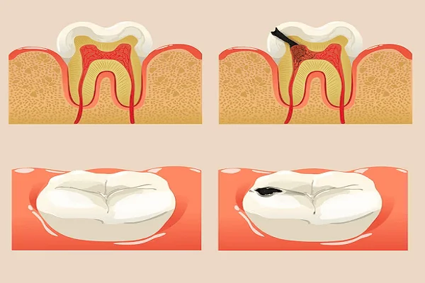 Daños en la estructura del diente