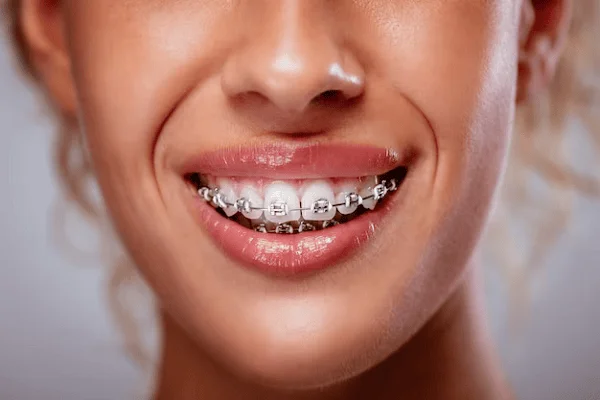Diferencias entre braclets y carillas