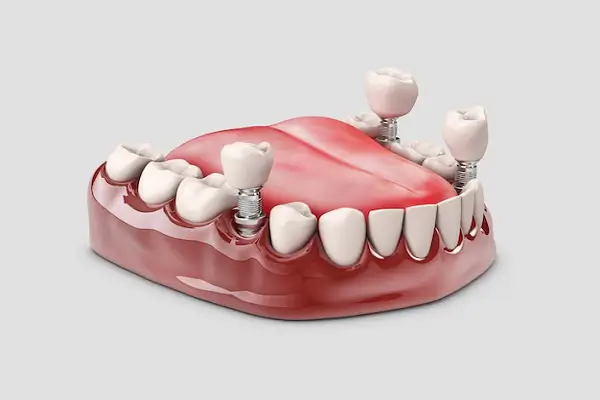 Implantes para mejorar la estética dental
