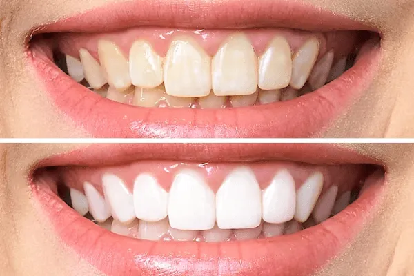¿Por qué se ponen las encías blancas?