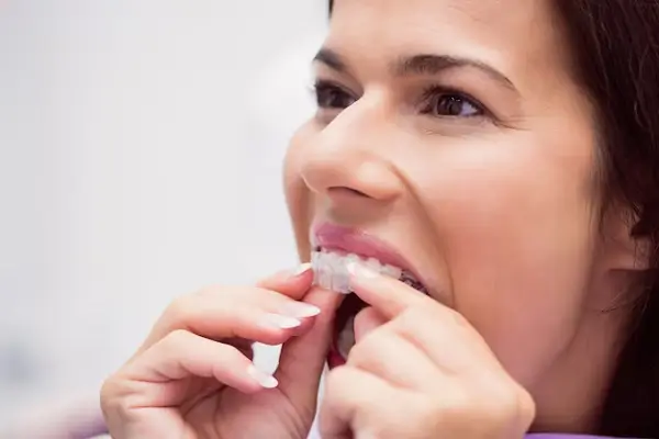 ¿Cómo Beneficia la Limpieza Regular a Tu Invisalign?