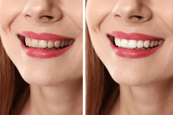 Transformación estética dental antes y después