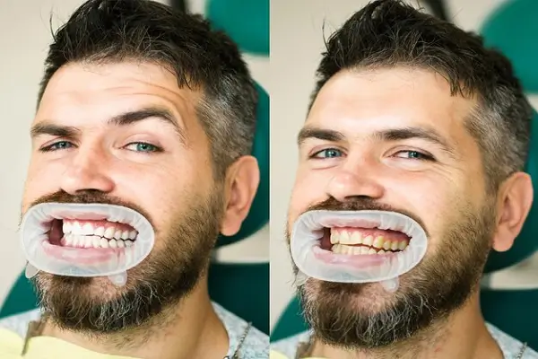 Antes y después de la periodontitis
