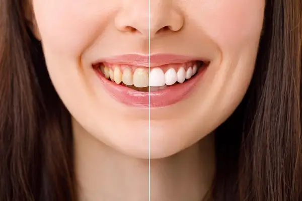 Antes y después del sarro en los dientes