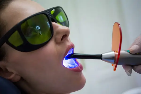 Consejos para el cuidado del blanqueamiento dental