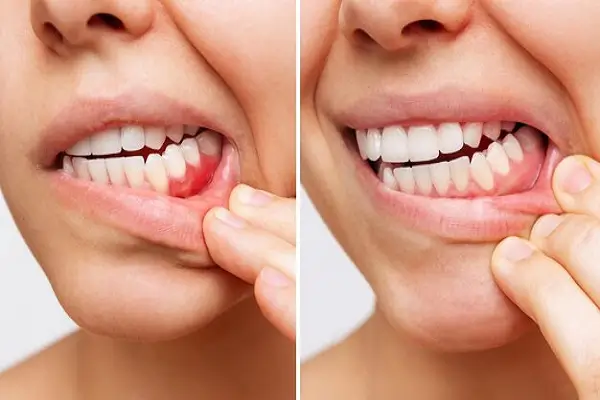 Periodontitis y Gingivitis Post-Tratamiento