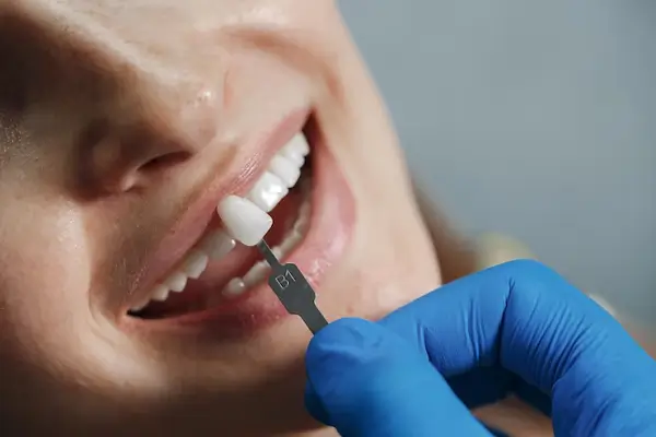Procedimientos de estética dental