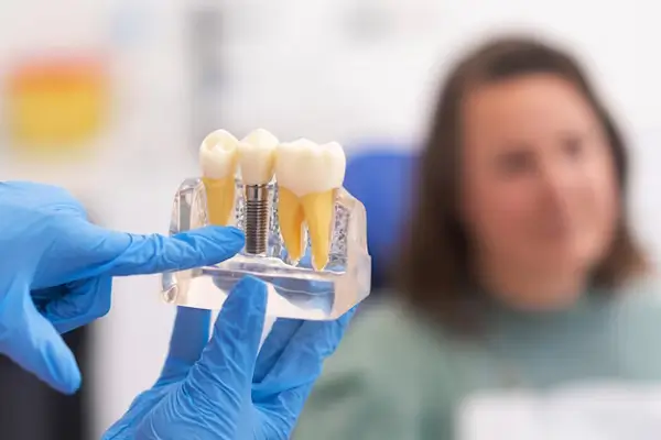 Proceso e instalación de implantes vs puentes dentales