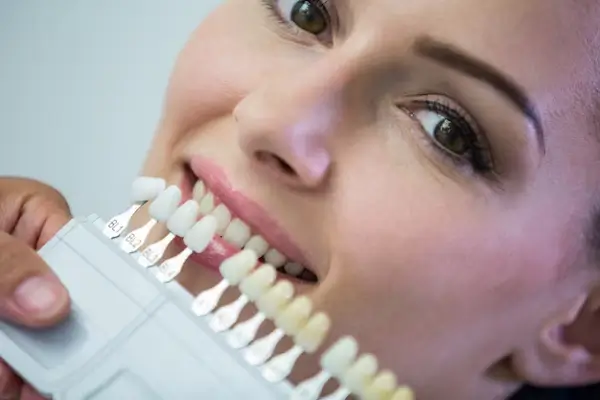 Tipos de carillas dentales