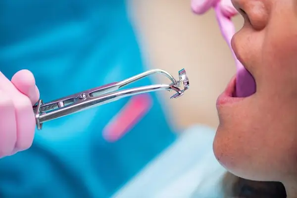 Todo sobre el piercing en la encía tendencias y cuidados