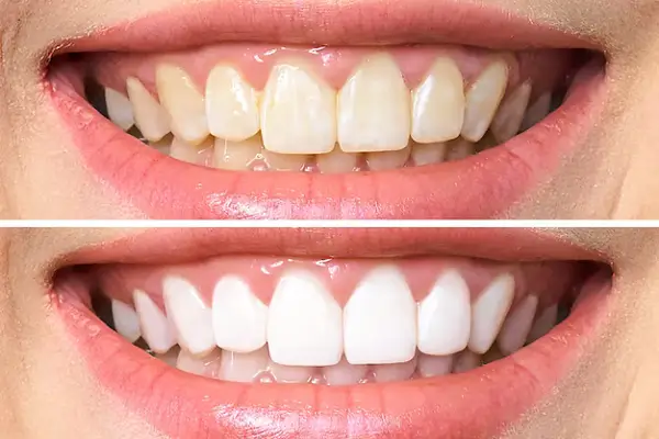Todo sobre la periodontitis Antes y después