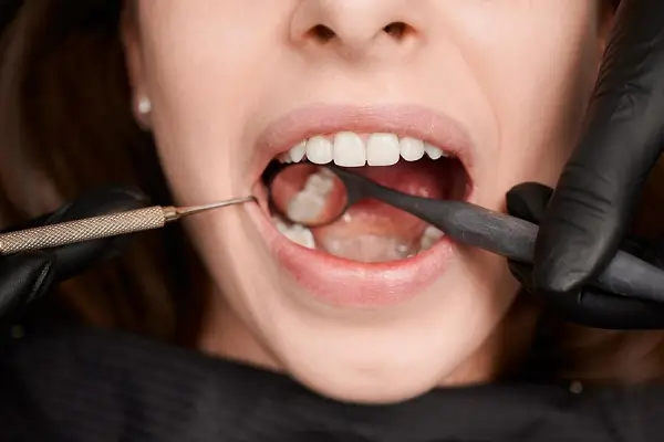 Eliminación de Manchas Marrones en los Dientes