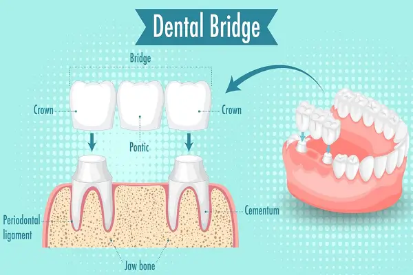 Puentes Dentales