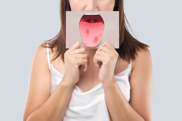 Tipos de infecciones en la lengua