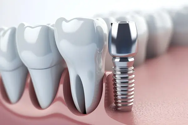 Cómo elegir un implante dental