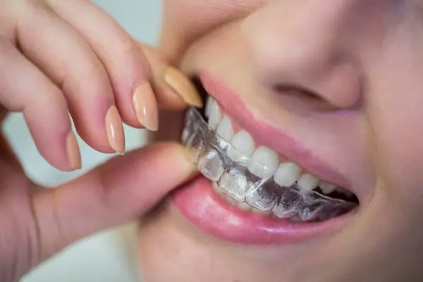 Comparando la ortodoncia invisible