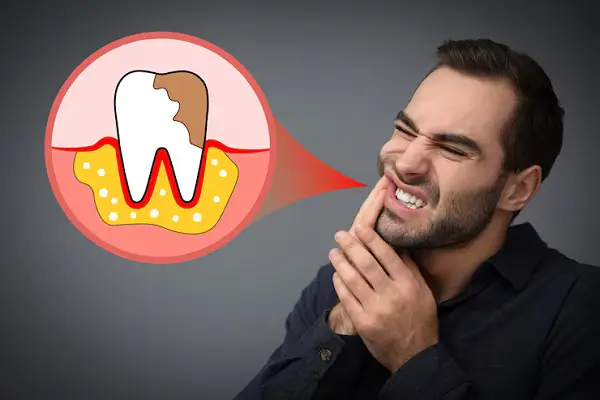 Consecuencias de la mala higiene dental
