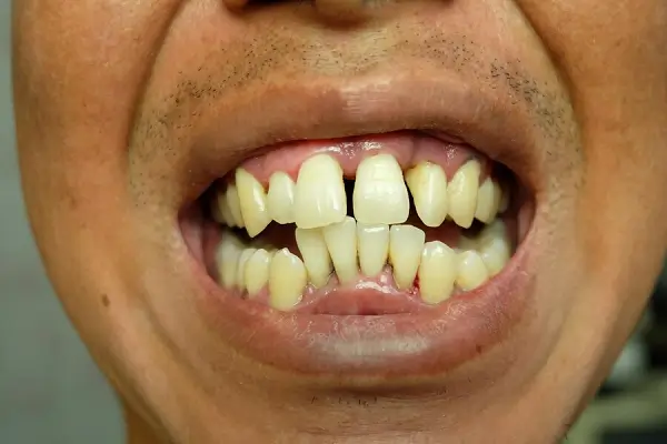 Entendiendo los Dientes Deformados: Causas, Tratamientos y Prevención
