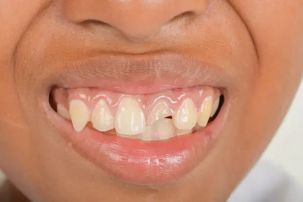 Entendiendo los Dientes Deformados: Causas, Tratamientos y Prevención