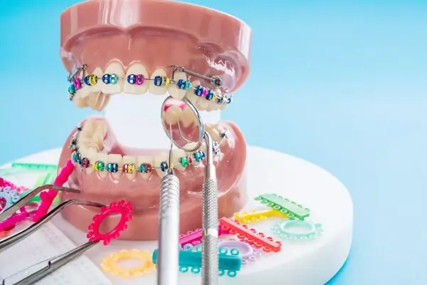 Explora la Variedad de Colores de Gomas para Brackets