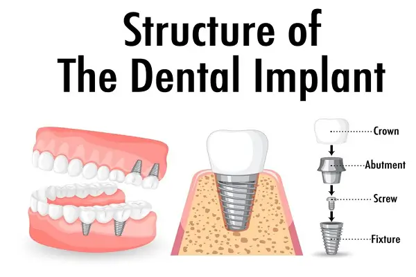 Guía completa para entender los implantes dentales