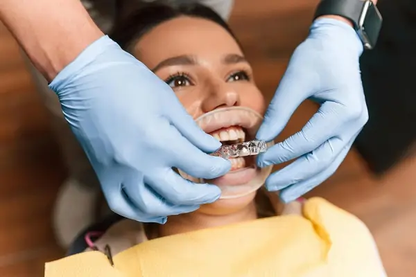 Guía completa para la colocación de brackets Un proceso paso a paso