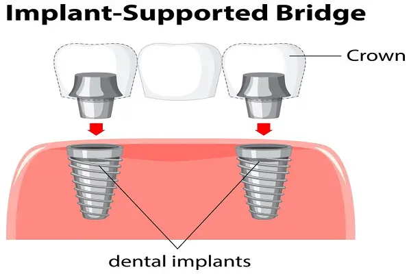 Guía completa de implantes dentales dobles y múltiples coronas
