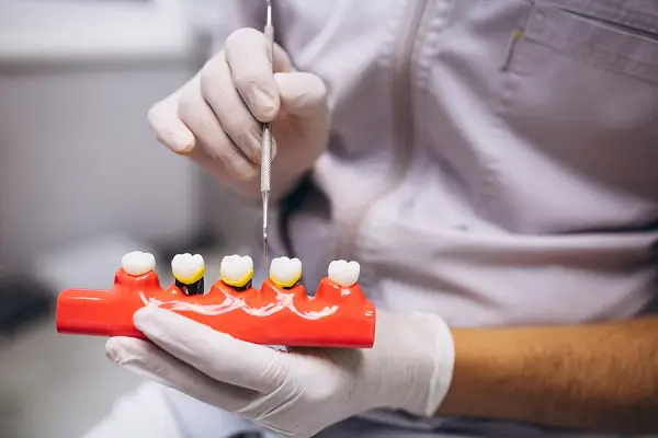 Guía completa para entender los implantes dentales