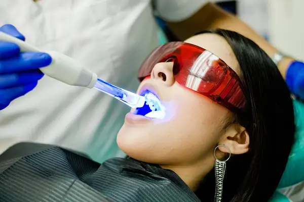 Guía profesional para el blanqueamiento dental