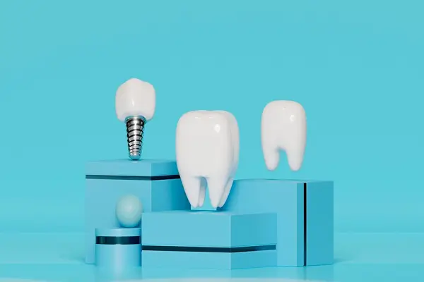 Todo lo que necesita saber sobre los implantes dentales