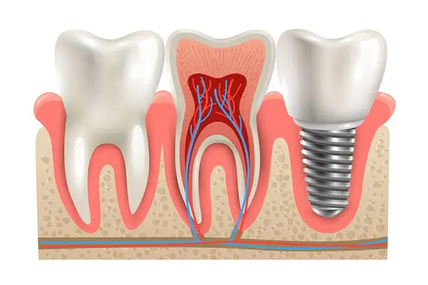 Guía completa para entender los implantes dentales