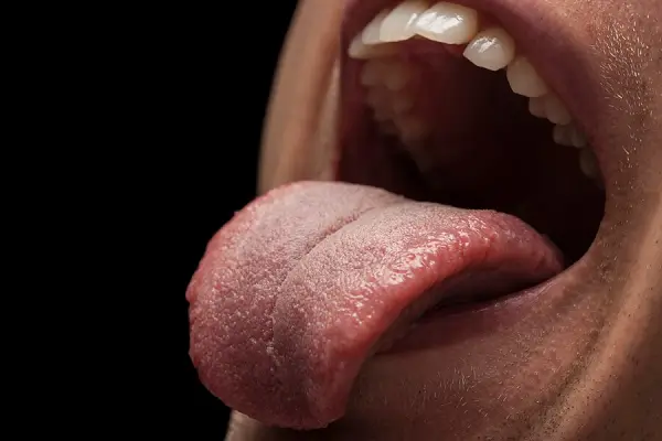 Infección en la lengua: Causas, síntomas y tratamiento