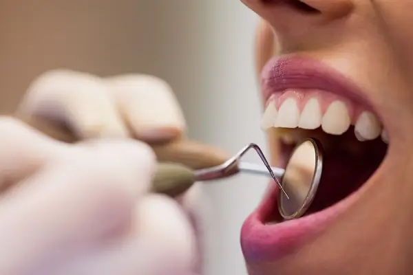 Los dientes paletos y su efecto en la sonrisa