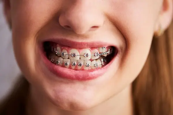 Mejorar problemas dentales con brackets