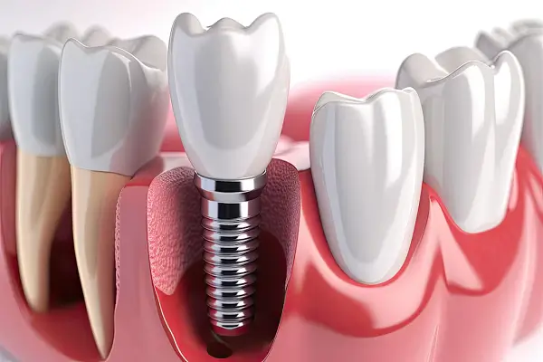 Todo lo que necesita saber sobre los implantes dentales