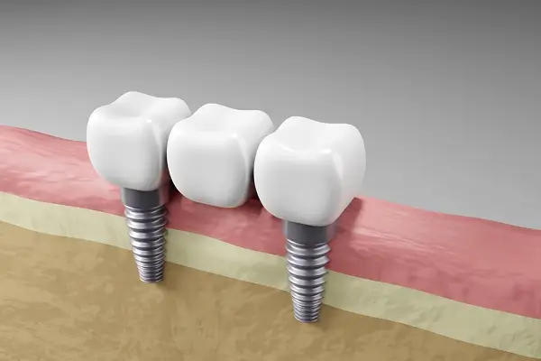 Todo sobre el Implante Dental Doble: Un Análisis Completo